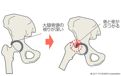 大腿骨頭の被りが深い 骨と骨がぶつかる