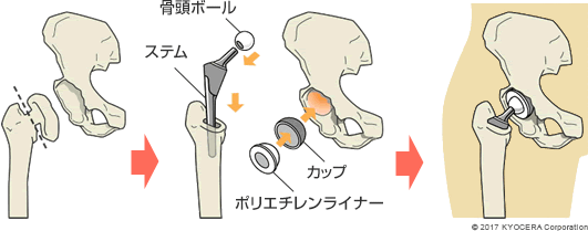 後述するセメントレスタイプの人工股関節置換術の例