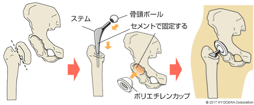 セメントタイプの人工股関節置換術の例