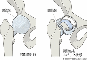 股関節外観 関節包をはがした状態