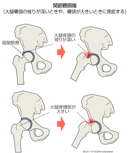 関節唇損傷（大腿骨頭の被りが深いときや、骨頭が大きいときに発症する）