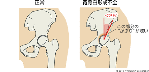 正常 寛骨臼形成不全