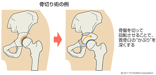 骨切り術の例