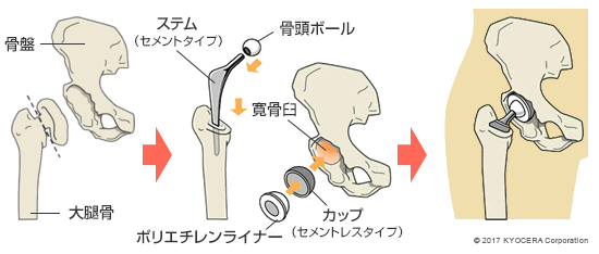 ハイブリッド固定の例