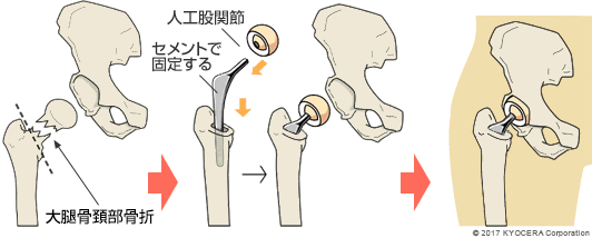 人工骨頭置換術の例