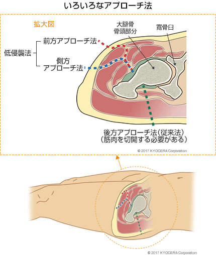 いろいろなアプローチ法