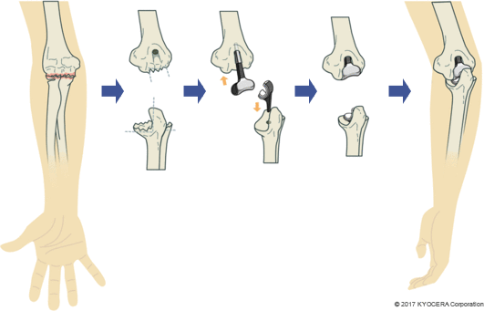 人工肘関節置換術の例