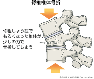 脊椎椎体骨折