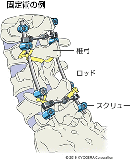 固定術の例