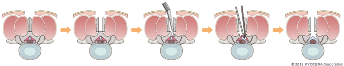 棘突起縦割式部分椎弓切除術の例