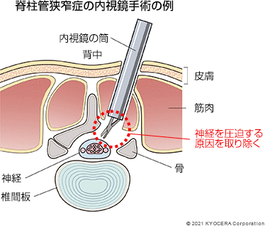 脊柱管狭窄症の内視鏡手術の例