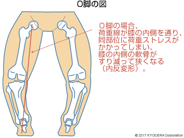 O脚の図