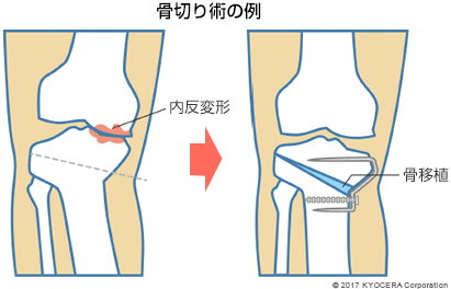 骨切り術の例