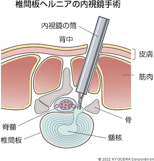 椎間板ヘルニアの内視鏡手術の例