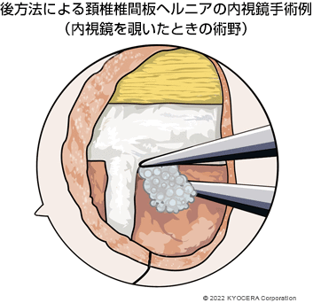 後方法による頚椎椎間板ヘルニアの内視鏡手術例（内視鏡を覗いたときの術野）