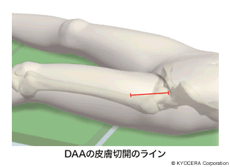 DAAの皮膚切開のライン