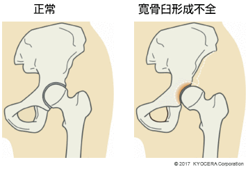 正常 寛骨臼形成不全