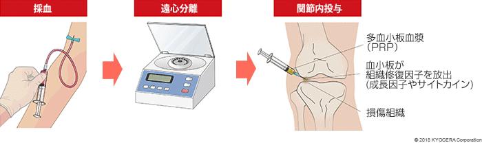 PRP療法イメージ図