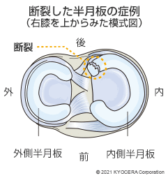 断裂した半月板の症例（右膝を上からみた模式図）