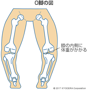 O脚の図