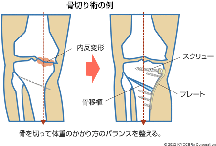 骨切り術の例