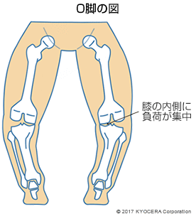O脚の図
