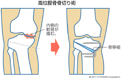 高位脛骨骨切り術