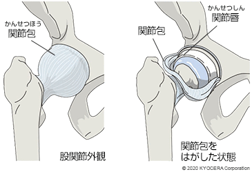 股関節外観 関節包をはがした状態