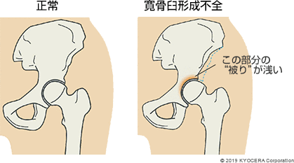 正常 寛骨臼形成不全