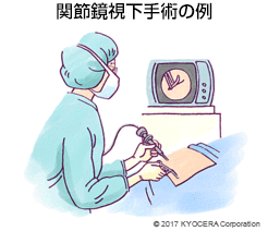 関節鏡視下手術の例