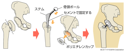 セメントタイプの人工股関節置換術の例