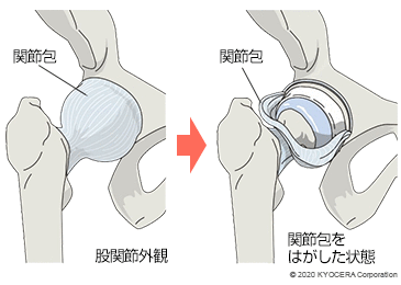 股関節外観 関節包をはがした状態