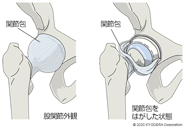 股関節外観 関節包をはがした状態