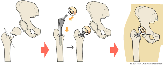 人工骨頭置換術（BHA）の例