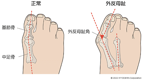 正常な足と外反母趾