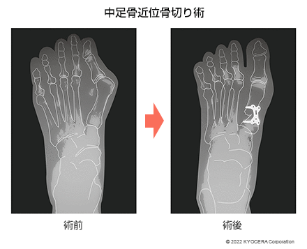 中足骨近位骨切り術