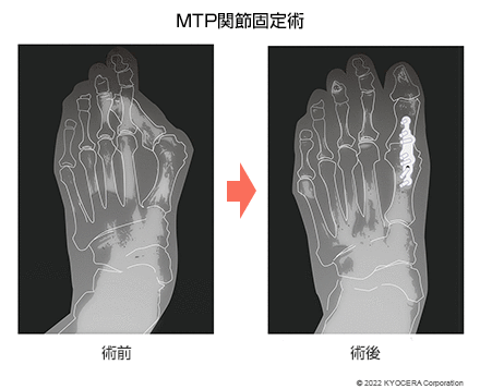 MTP関節固定術