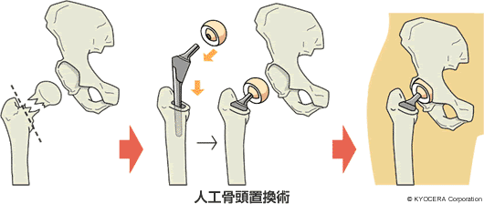 人工骨頭置換術