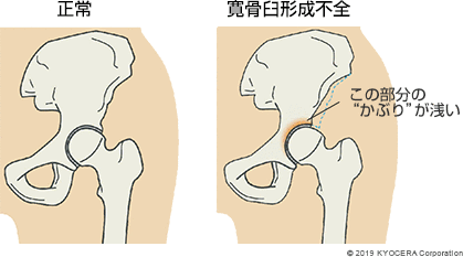 正常　寛骨臼形成不全