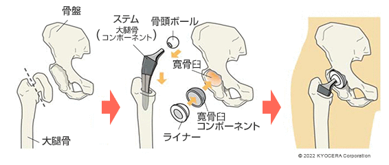 人工股関節置換術の例