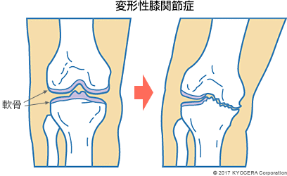 変形性膝関節症