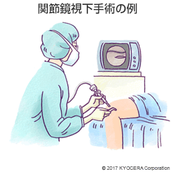 関節鏡視下手術の例