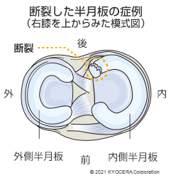 断裂した半月板の症例（右膝を上からみた模式図）