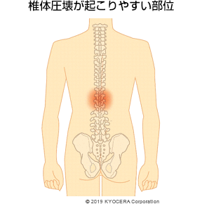 椎体圧壊が起こりやすい部位