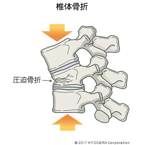 椎体骨折