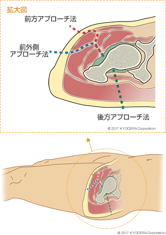 さまざまなアプローチ法