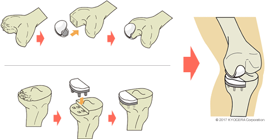 人工膝関節単顆置換術