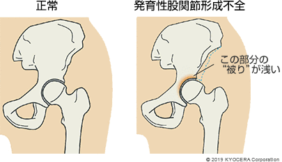 正常 発育性股関節形成不全