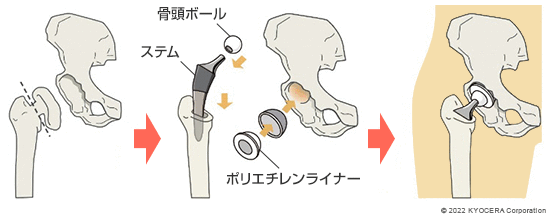 人工股関節置換術