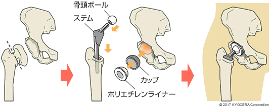 セメントレスタイプの人工股関節置換術の例